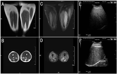 Frontiers Case Report Novel Etfdh Compound Heterozygous Mutations Identified In A Patient